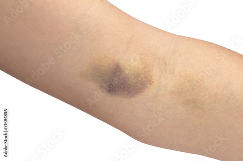 bruise on the white background