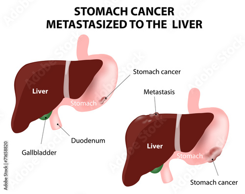 Stomach cancer Metastasized to the  liver photo