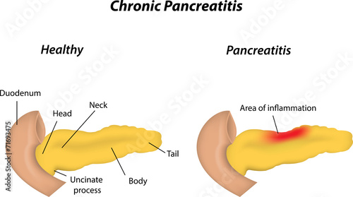 Chronic Pancreatitis
