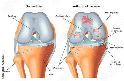 artrosi del ginocchio photo