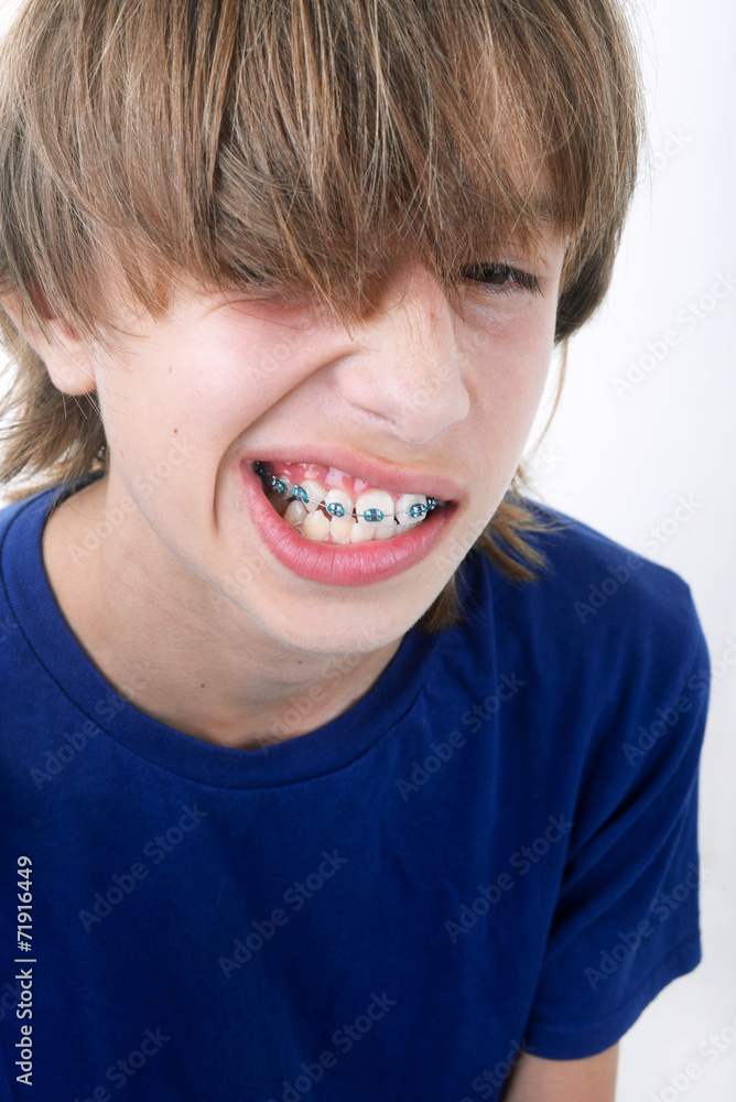 Enfant montrant son baguage orthodontique Enfant montrant son baguage orthodontique