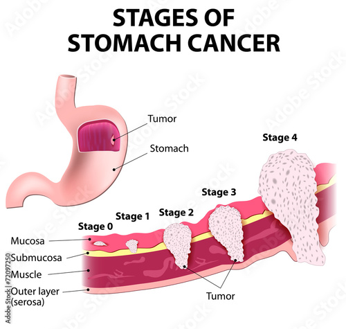 Staging of stomach cancer