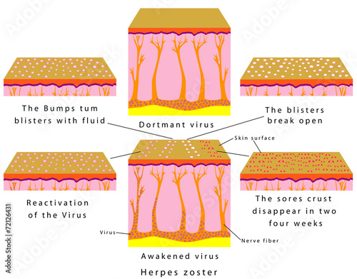 Herpes zoster