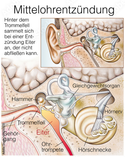 Mittelohrentzündung photo