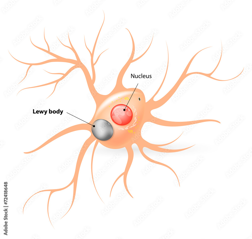 Lewy body. Parkinson's disease and Alzheimer's disease Stock Vector