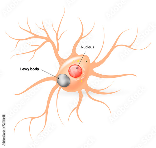 Lewy body. Parkinson's disease and Alzheimer's disease photo