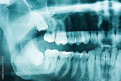 Panoramic Dental X-Ray Of Human Teeth