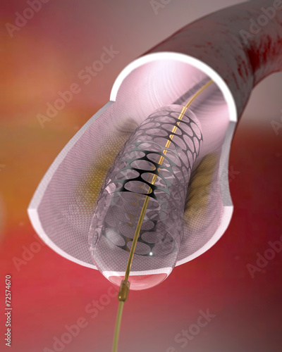 Sezione di un'arteria con stent inserito. Inserimento chirurgico photo