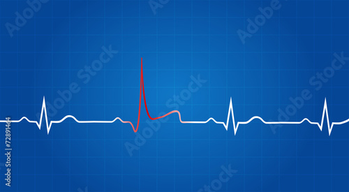 Blueprint Of Heart Attack On Electrocardiogram