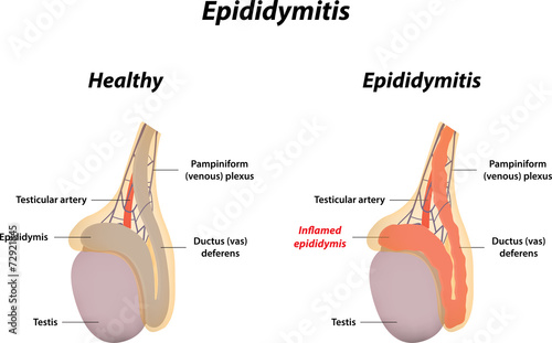 Epididymitis photo