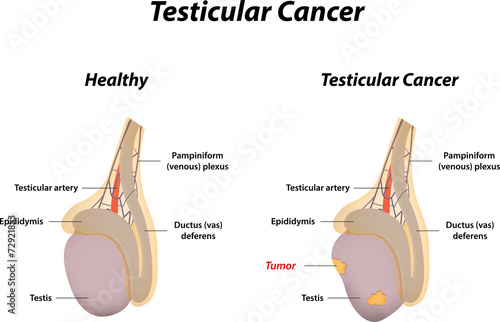 Testicular Cancer