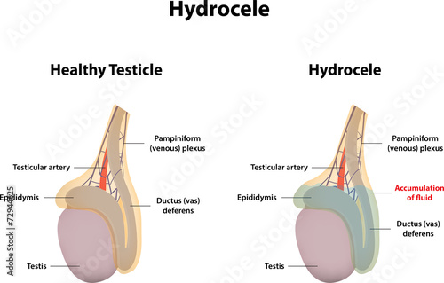 Hydrocele photo