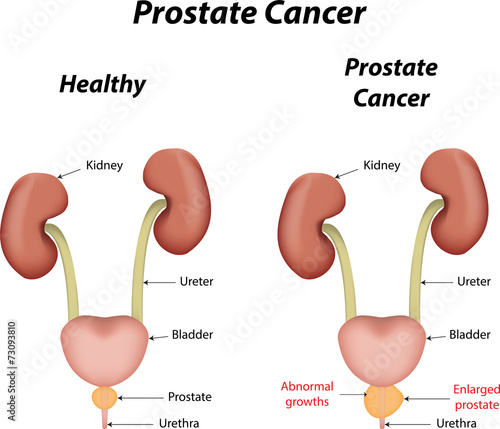 Prostate Cancer