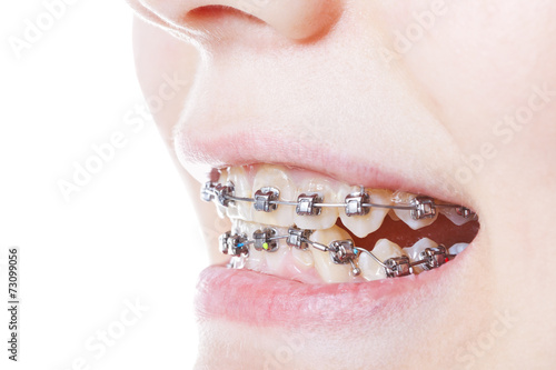 dental steel braces on teeth close up