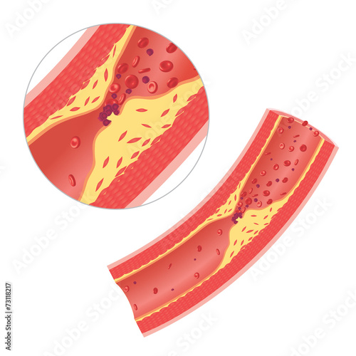 Athersclerosis in artery