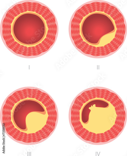 Athersclerosis stages