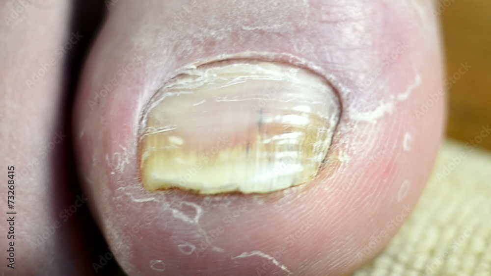Nail fungus closeup Nail fungus closeup