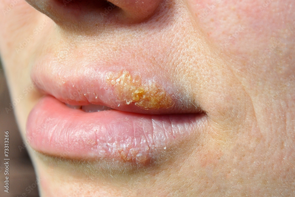 Fototapeta premium herpes