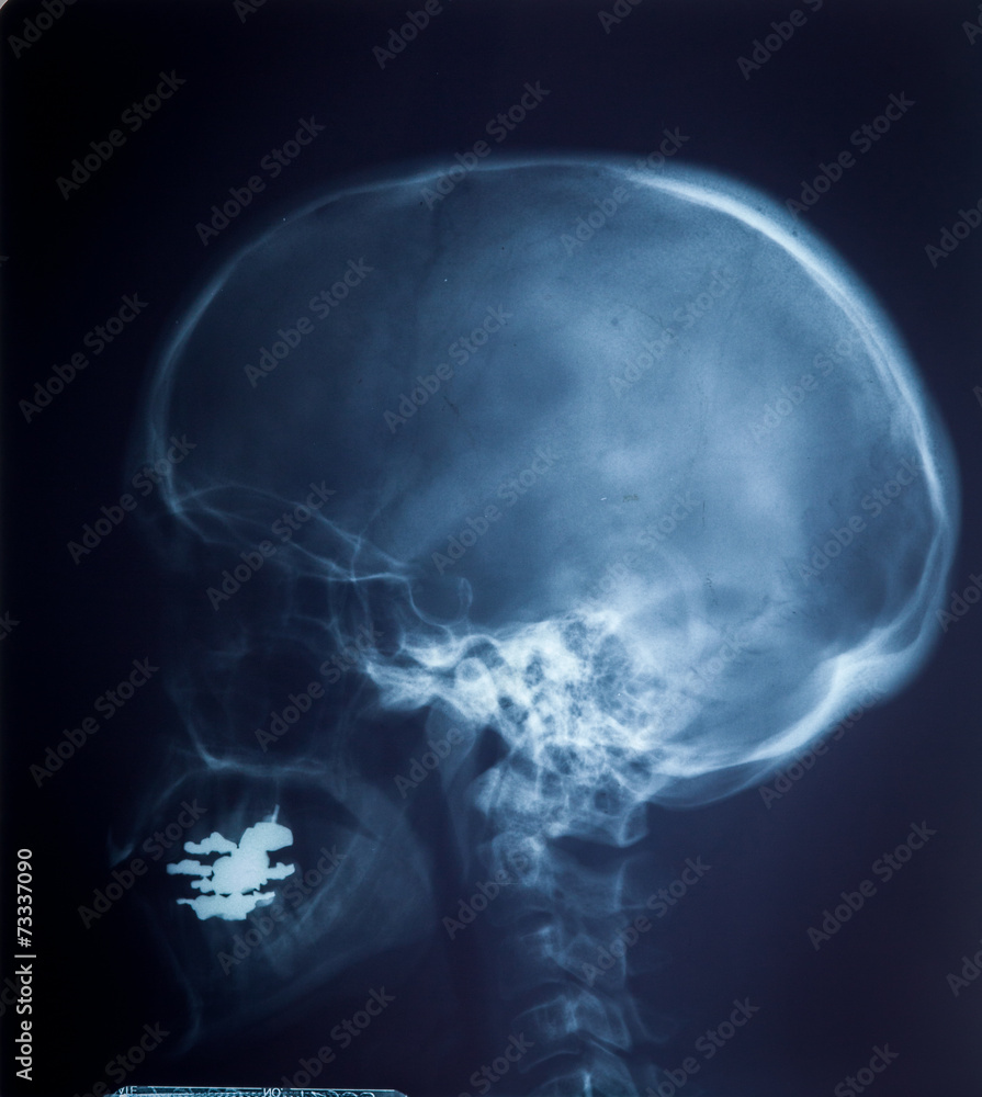X ray MRI - Image of Spinal Column Neck pain and Skull Head Stre X ray MRI - Image of Spinal Column Neck pain and Skull Head Stre