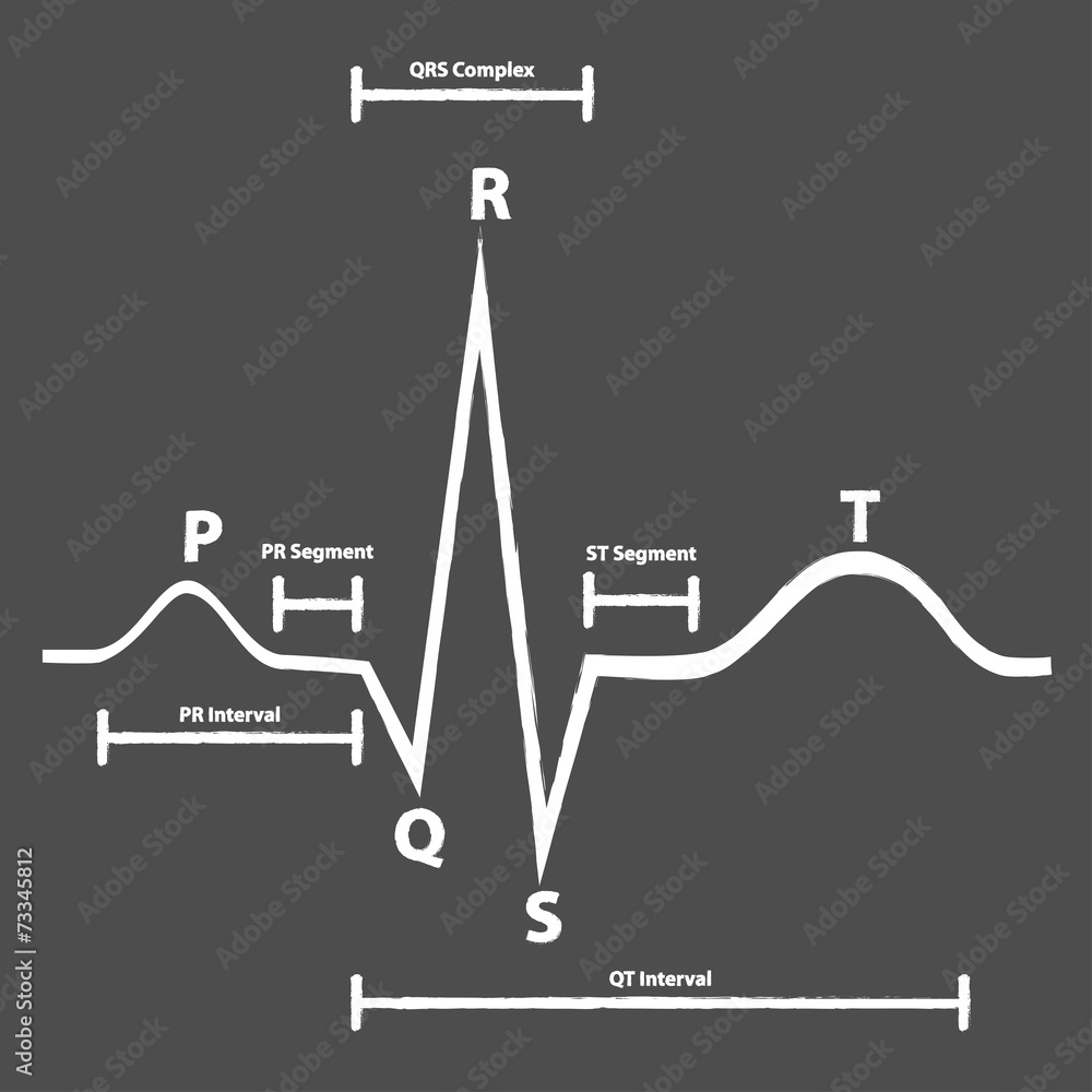 Normal Electrocardiogram Graphic Explained On Blackboard