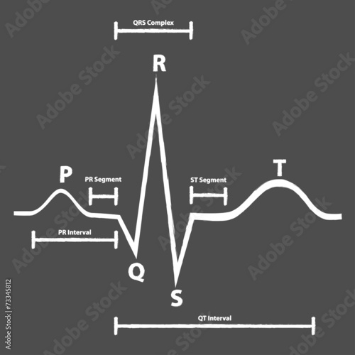 Normal Electrocardiogram Graphic Explained On Blackboard