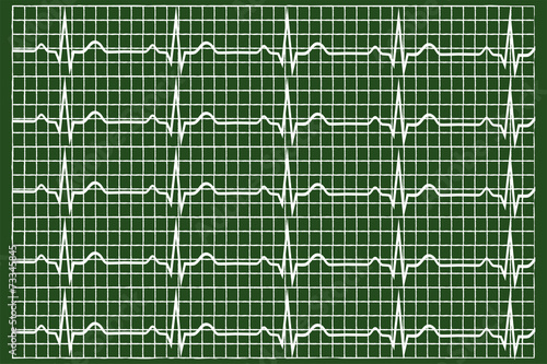 Normal Electrocardiogram Graphic On Green Chalkboard