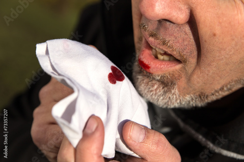 Mann hustet Blut in ein Taschentuch photo