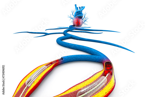 Stent angioplasty procedure with placing a balloon photo