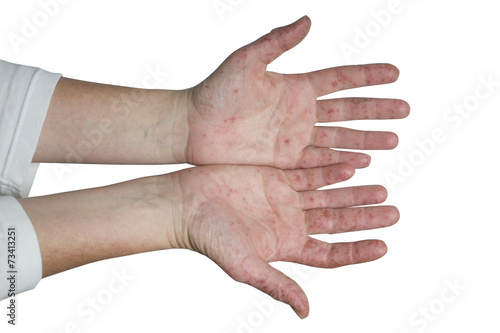 Hand-Fuß-Mund-Krankheit, Hände photo