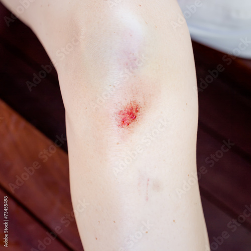 Injured female knee