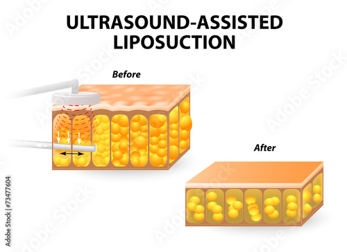 Ultrasound-assisted liposuction