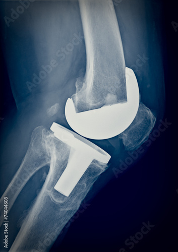 Bicompartmental knee prosthesis xray
