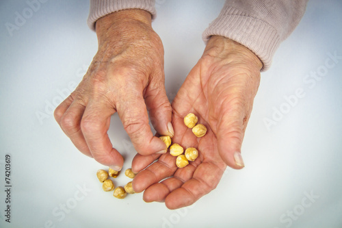 Rheumatoid arthritis hands
