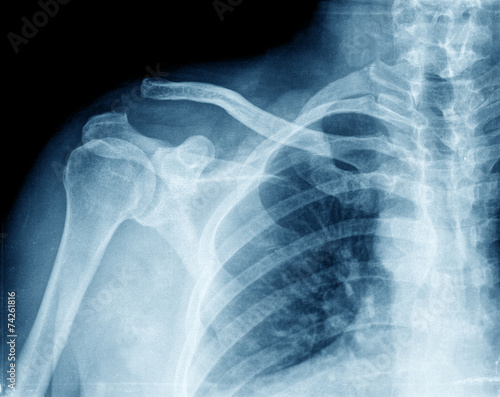 x-ray chest photo