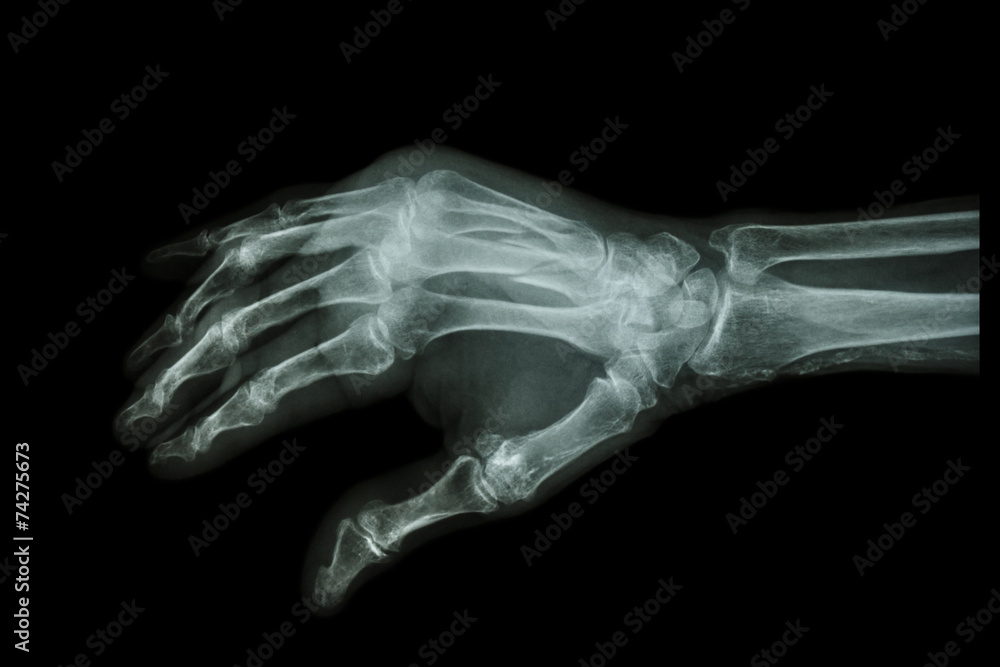 Naklejka premium Fracture at 3rd and 4th metacarpal bone