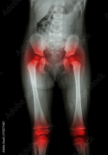 body of child and arthritis both hip,both knee(Gout,Rheumatoid)