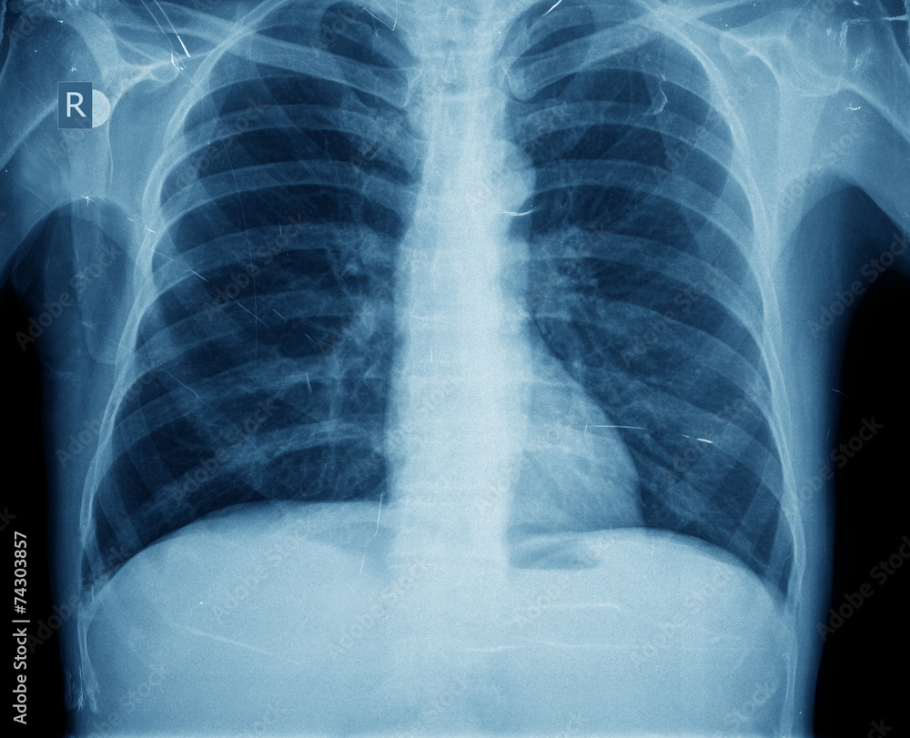x-ray chest man x-ray chest man