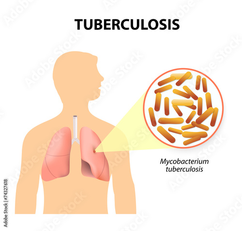 Tuberculosis, MTB or TB