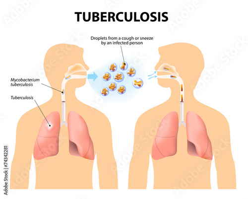 Tuberculosis photo