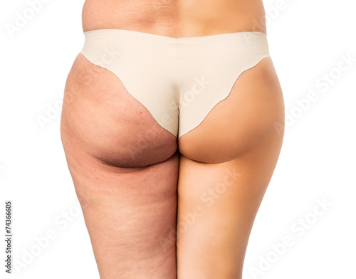 Cellulite treatment, before and after