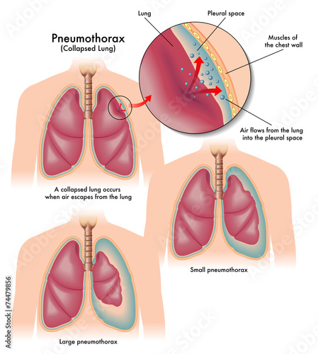 pneumotorace