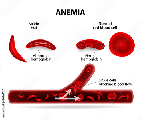 anemia photo