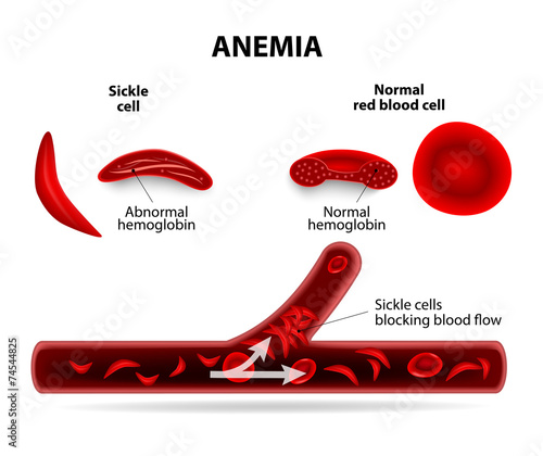 anemia