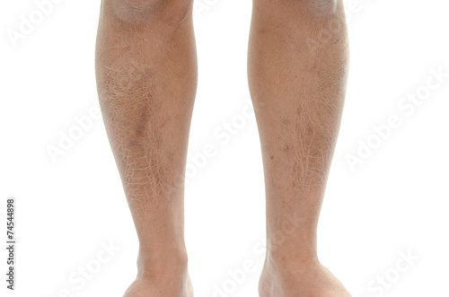 Closeup texture of bad skin leg