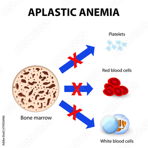 aplastic anemia