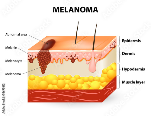 Melanoma or skin cancer photo