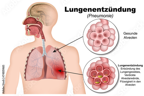 Lungenentzündung, Pneumonie photo