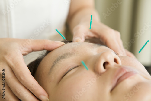Acupuncture for beauty