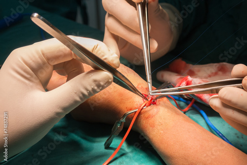 arteriovenous fistula operation for dialysis photo