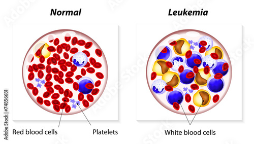 Leukemia or leukaemia